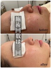 マルコ(marco)/肌質改善☆症例　(3回)