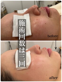 マルコ(marco)/肌質改善☆症例　(3回)