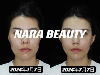 ナラビューティー(NARA BEAUTY)/小顔コルギ矯正 12回