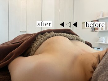 リノ 行橋(lino)/◇バストアップ症例◇30代