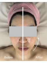 ハナ トータル ケア(Hana Total Care)/ブラシテクニックでリフティング