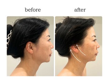 フロリール アザブジュウバン(FlorirAzabujuban)/3D小顔/造顔フェイシャル