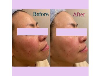 ベルローズ ラパーク 金沢店/レチノールビフォーアフター