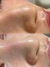 【美肌の基本メニュー】毛穴洗浄＋イオン導入