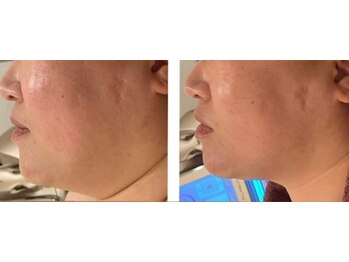 シャトン ボーテ(chaton beaute)/レモンボトルビフォーアフター☆