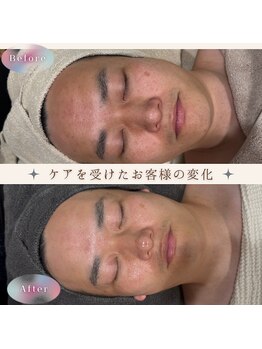 美肌研究所 絹 田辺店/男性のシミもハーブピーリングで