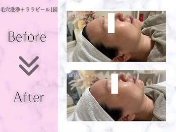 リライフ(ReLIFE)/韓国肌管理/毛穴洗浄+ララピール