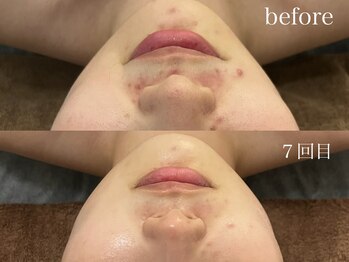 サロンワイアネシス(Salon y ANESIS)/ハーブピーリング　7回の変化