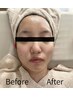 1度で実感!小顔Vリフト (首~お顔)