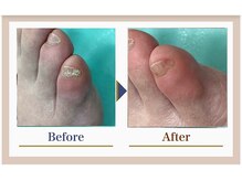 巻き爪補正店 錦糸町店/【副爪ケア】