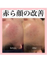 エクラーレ(Eclale)/ハーブピーリング症例