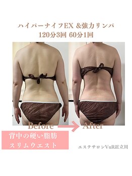 エステサロン ヴリエ 立川店/★ハイパーナイフEX★3回