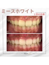 ミースホワイトニング(mys whitening)/ビフォーアフター【歯科提携】