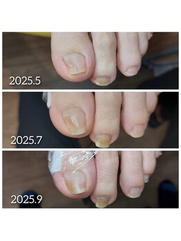 【歩行と爪の関係】