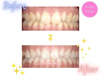 エクシアホワイトニング 新百合ヶ丘店/ホワイトニングビフォーアフター
