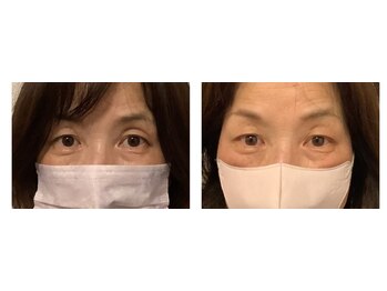 甲陽園鍼灸わたぐも/目の窪みの改善