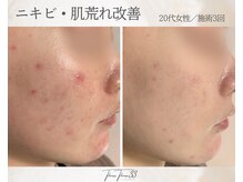 スリースリー 恵比寿(THREE THREE)/ニキビ・肌荒れケア