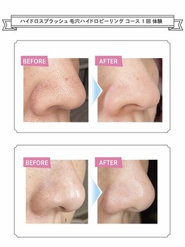 リンド(lindo)/毛穴洗浄