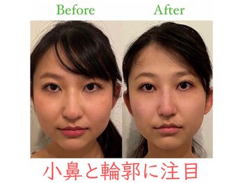 ラプリ 福岡博多店(Raplit)/ 隆鼻+輪郭・小顔矯正 美鼻/小顔