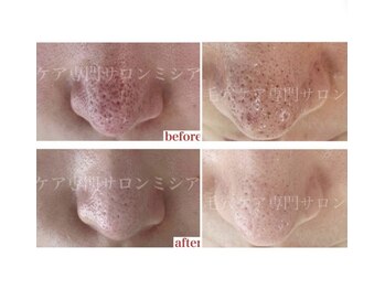 リュミエール デスポワール(Lumiere d'espoir)/毛穴ケア