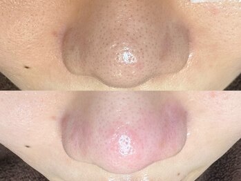 エクラ バイ シャンリィ(eclat by shanLy)/黒ずみ解消