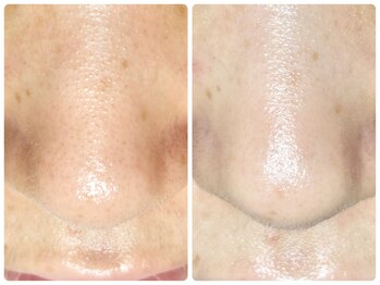 ラウン 京都(ROUN')/ EIEN1回の施術ビフォーアフター