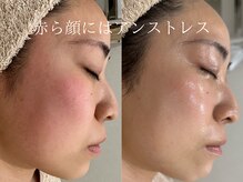 ラシュール(Rassure)/お客様before/after