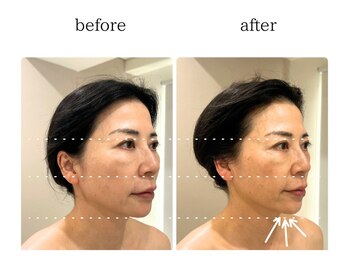 フロリール アザブジュウバン(FlorirAzabujuban)/3D小顔/造顔フェイシャル