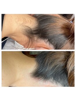 プルメリア(Plumeria)/うなじ脱毛