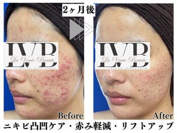 ラヴレボーテ(La Vraie Beaute)/肌改善途中経過