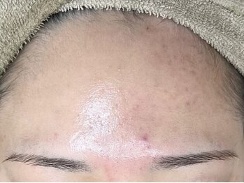 スワッグ(SWAG)の写真/剥離なしのハーブピーリングでお肌のターンオーバーを正常化し、古い角質を除去!憧れのたまご美肌へ♪