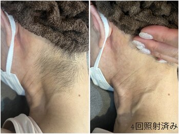 レイズ(RAISE)/脱毛before →after 