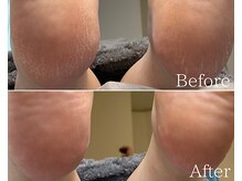 カシェット 広島店(Cachette)/30代女性☆足裏角質ケア60分