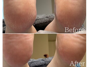 カシェット 広島店(Cachette)/30代女性☆足裏角質ケア60分