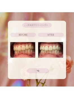 プラスビーセルフ(+b self)/ホワイトニングビフォーアフター