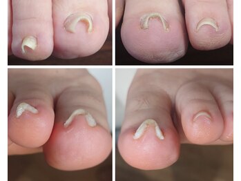 アンティ(Aunty)/つらくない巻き爪補正