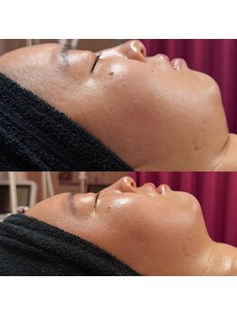 【ハーブピーリング/毛穴洗浄/小顔リフト】total beauty salon mayahime 大宮店/オンダリフト