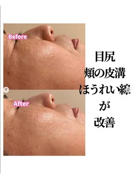 ビューティスト(Beautist)の写真/気になるほうれい線やシワの改善をサポート♪20年以上の実績で自信が持てる上質な素肌へ導きます◎