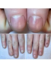 ココデネイル(cocode nail)/悩み:爪の形が悪い(20代前半)