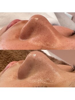 アール(ar.)/毛穴洗浄フェイシャル