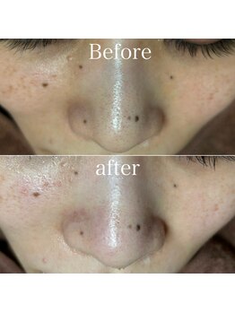 ペイジ(peige)/【peige】症例写真