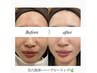 短期ケア★憧れの韓国肌【肌質改善】ハーブピーリング×3回 55500⇒31000