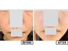 ビビ(VIVI)/ハーブピ―リングシミケアの症例