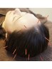 【発育毛鍼灸×全身調整】頭皮の筋肉をほぐし、血行改善◎《¥6000→¥3000》