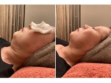 ミモザの雰囲気（エアインジェクションによるエイジングケアでお首元がスッキリ♪）