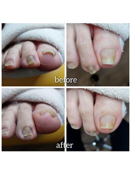 【巻き爪サイドカット】