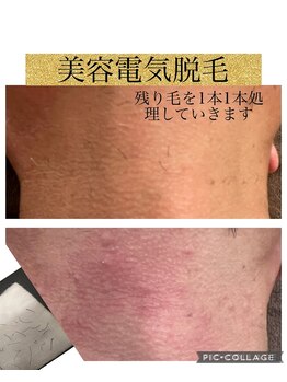 サロン ド ソレイユ(Salon.de.Soleil)/首髭の残りげを処理