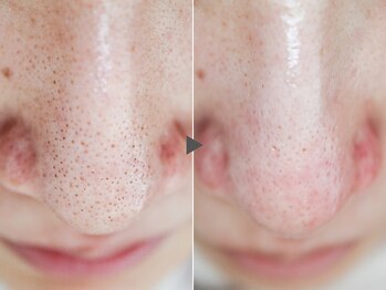 クリード(CLEAD)/ハイドラフェイシャル/毛穴洗浄