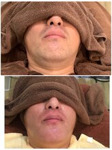 叶(Kanau)/髭脱毛