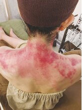 癒しの森/スライドカッピング